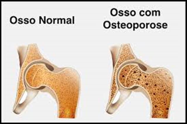 Dia Mundial de Combate à Osteoporose
